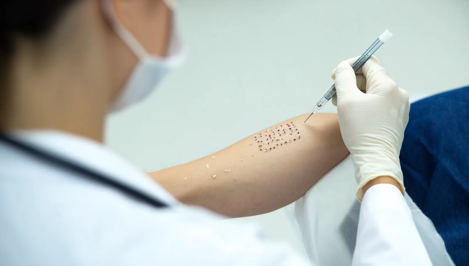 An allergist wearing gloves performs a skin-prick test on a patient's forearm, with small marked test sites arranged in a neat grid.